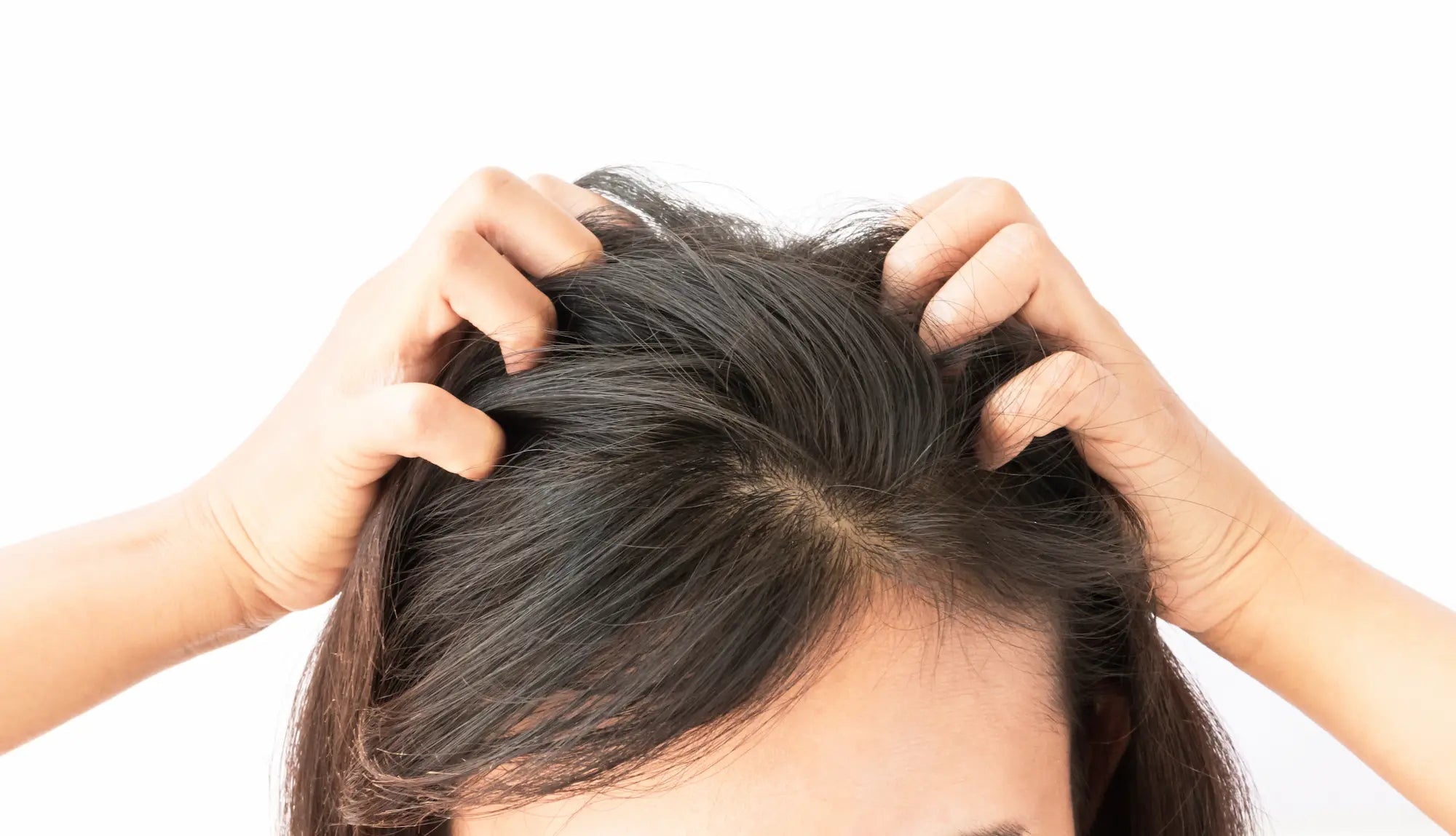dandruff vs dry scalp
