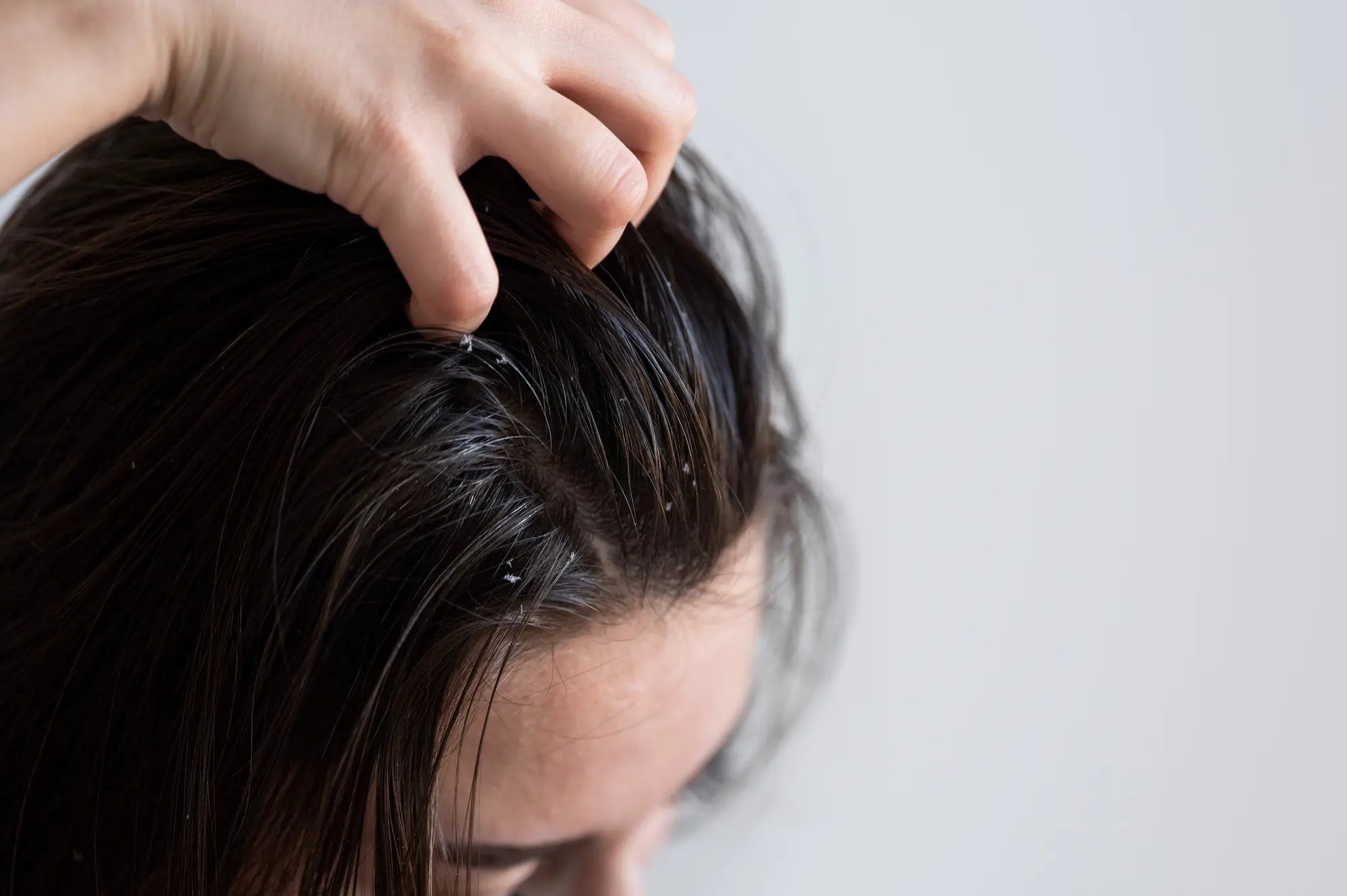 What Is Scalp Buildup and How to Treat It